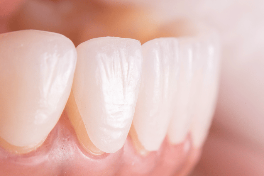 Dental Veneers Fix Chipped, Gapped, or Misshapen Teeth